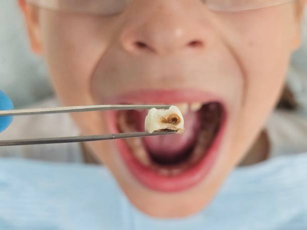 Best Emergency Treatment for Dental Infections or Abscesses in Lacy Lakeview, TX